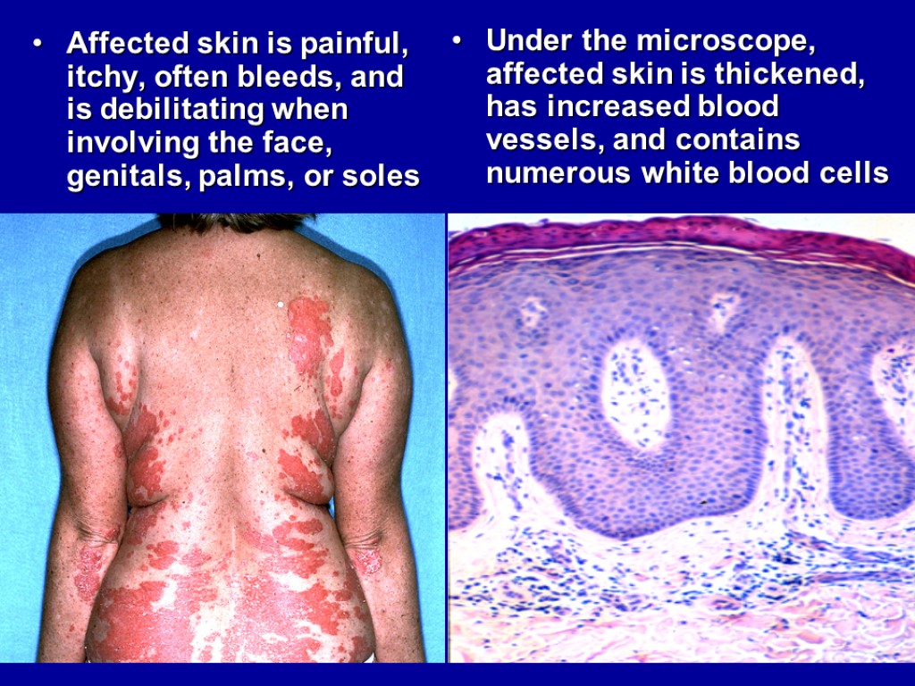 Affected skin is painful, itchy, often bleeds, and is debilitating when involving the face,